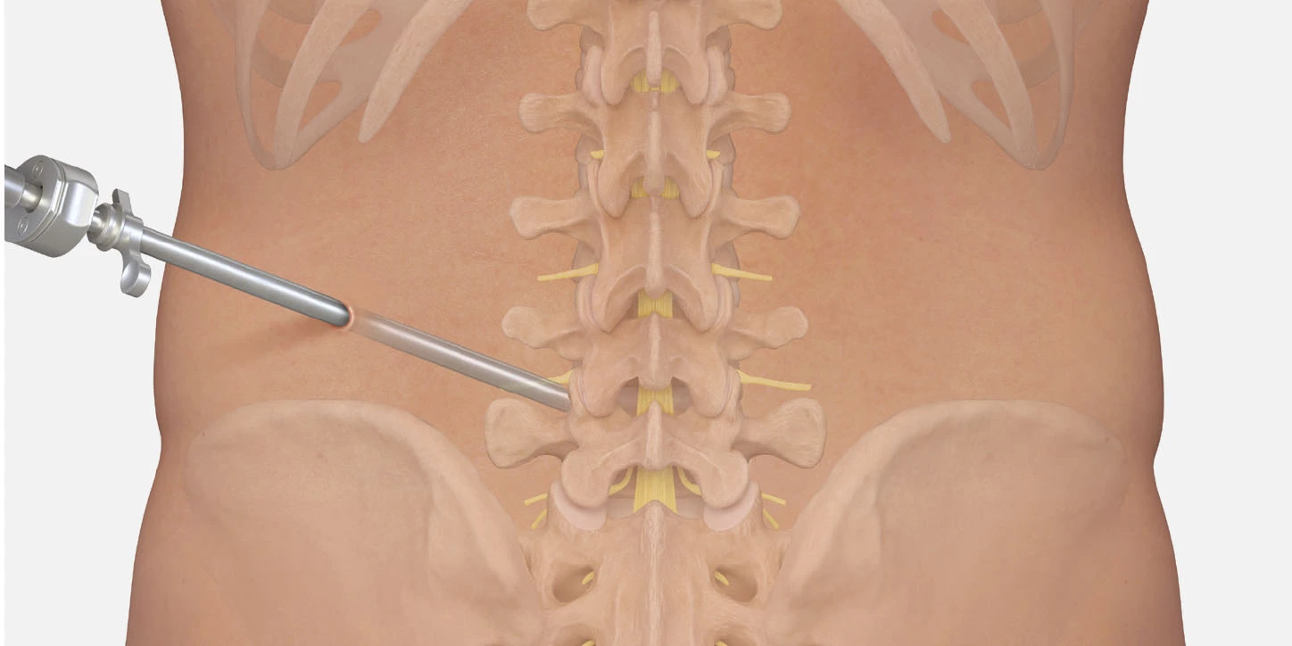 Ilustração mostrando como o endoscópio é utilizado na cirurgia endoscópica da hérnia de disco